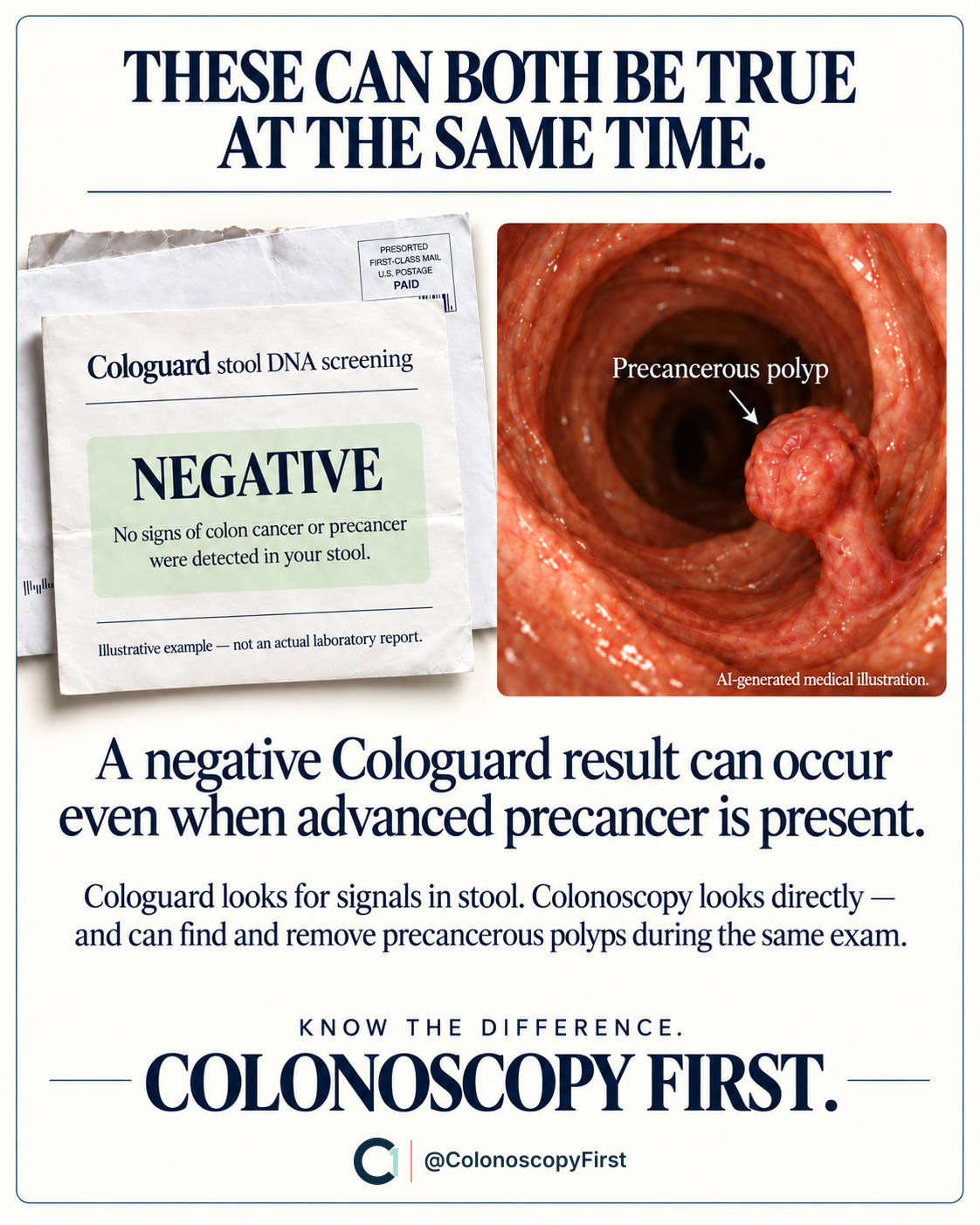 Illustrative negative stool DNA report beside a labeled AI-generated polyp image: a negative result and precancer can coexist.